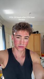 @Dr Ahmed El Muntasar 24 hours post iPixel CO2 laser treatment #acne  #acnescars #acnescartreatment #co2laser