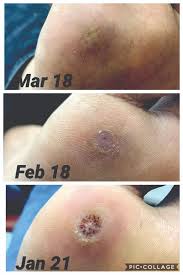 The management of recalcitrant common warts can be frustrating to patients and dermatologists alike. Current And Emerging Concepts In Wart Treatment Podiatry Today