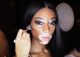 La vitiligine è una malattia che colpisce i melanociti, le cellule della pelle che producono la melanina. Vitiligine Cos E E Perche Non Devi Nasconderla