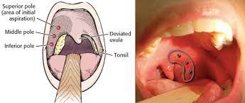 All You Need To Know About Peritonsillar Abscess Covington Smiles