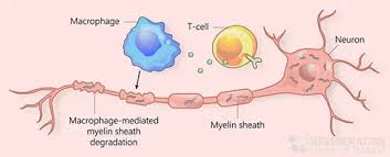Communicable (infectious and parasitic diseases and maternal, perinatal and nutritional at a global level, 7 of the 10 leading causes of deaths in 2019 were noncommunicable diseases. Neurogenic Stem Cell Treatment Of Als W Msc Stem Cells