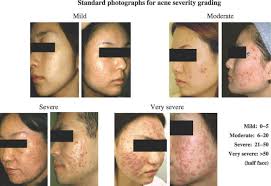 Typical features of the condition include blackheads or whiteheads. Acne Clear Skin Apax Medical Aesthetics Clinic