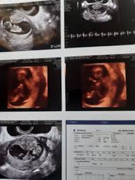 Ecografia 11 Semanas Club De Bebes Noviembre 2020 Babycenter