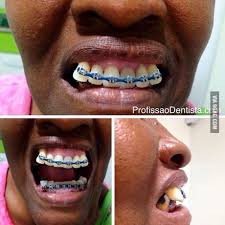 And if you're making them at home, then they would fake braces that look real are far more hazardous than perceived. If You Use Fake Braces 9gag