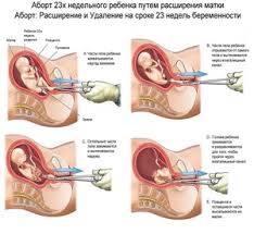 Na Kakom Mesyace Beremennosti Mozhno Sdelat Abort