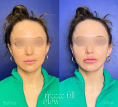 Nurse Melissa|Botox•Filler Fat Dissolving•Natural Results  (@melissa.freezefillglow) • Instagram photos and videos