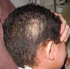 Certain conditions can cause an itchy scalp and hair loss. Why Does This Boy Have An Itchy Scaly Scalp With Hair Loss Pediatrics