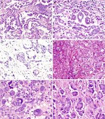 Mesothelioma Springerlink