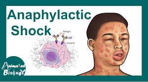 Image result for Anaphylaxis