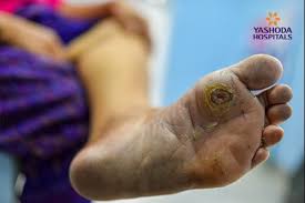 The bones become weak and can break and the joints in the foot or ankle can dislocate. Diabetic Charcot Foot What Is Diabetic Charcot Foot Its Causes