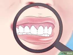 Größtenfalls ist er etwa 0,5cm groß. Erkennen Ob Du Mundkrebs Hast 15 Schritte Mit Bildern Wikihow