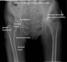 Xray Anatomy Of The Hip Medical Radiography Radiology Imaging Medical Anatomy