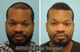 Hair transplants for african american hair hair transplant on those of african american descent is more difficult than caucasian or asian ethnicities due to the curly hair and root. Ethnic Hair Restoration Dallas Ethnic Hair Surgery Plano Tx