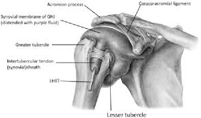 Image result for Biceps Tendon Injection