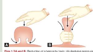 Image result for Hernia Reduction