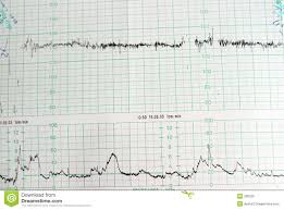 Medical Chart Stock Photo Image Of Chart Monitoring