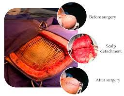 We did not find results for: Materials Free Full Text Nanoparticles And Nanostructured Surface Fabrication For Innovative Cranial And Maxillofacial Surgery Html