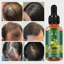 Ginger root is a good remedy for treating hair loss because it helps in making the hair follicles strong. Buy Tonik Pelebat Rambut Hair Loss Treatment Ginger Hair Growth For Thicker Healthier Hair Hair Care Seetracker Malaysia