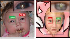 Smartphone App Can Help Detect Leukocoria A Sign Of Eye Cancer Shots Health News Npr