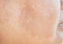 Maybe you would like to learn more about one of these? Uneven Skin Tone Ozmedica Aesthetic Clinic Melbourne