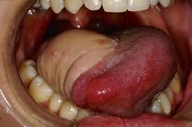 Image result for cancer of tongue