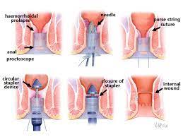 Pentru tratarea eficienta, dar si pentru a evita agravarea hemoroizilor este important sa stim care sunt cele mai tratamentul hemoroizilor in functie de stadiul lor de dezvoltare. Boala Hemoroidala Metode De Tratament Centrul Medical Memormedcentrul Medical Memormed