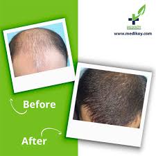 Many people notice hair loss after surgery, but it's usually three months after the operation has taken place, which can be alarming for many. Best Hair Transplant In Turkey Hair Transplant Specialist Medikoy