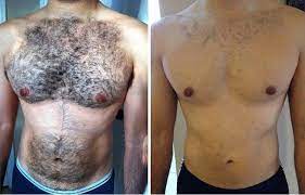Laser Hair Removal Affiliated Dermatology Laser Hair Removal Men Laser Hair Removal Face Hair Removal Cream
