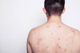 Image result for skin rash acute hiv infection