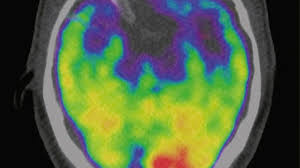 Stress Fuhrt Zu Entzundungen Im Korper Ganz Ohne Keime Gesundheit Sz De