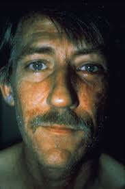 Image result for Photodermatitis