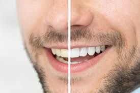 How to whiten teeth in photos. How Much Does Teeth Whitening Cost In Massachusetts Emerson