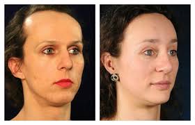 Facial Feminization Surgery Before After Facial Feminization Surgery Facial Surgery Male To Female Transformation