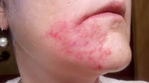 Our very own pharmacist explains the benefits of coconut oil to treat baby eczema. A Little Bit Of Sugar For Perioral Dermatitis A Little Bit Of Sugar