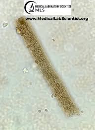 Image result for Urinary Cast