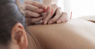 Le Billet De Pauline J Ai Teste L Acupuncture Pour Maigrir Fourchette Bikini