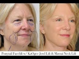 Ponytail Facelift W Kaogee Jowl Lift Massai Neck Lift Youtube Plastic Surgery Face Lift Surgery Facial Aesthetics