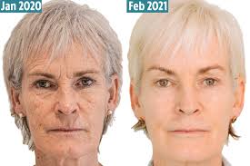 We did not find results for: Judy Murray Undergoes 4 5k Facelift Procedure After Being Mocked By Tennis Star Sons Andy And Jamie For Turkey Neck