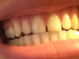 There are a range of options to choose from, including orthodontia, which you can read about closing gaps in teeth is reasonably straightforward and traditional braces aren't always necessary. The Gap Between My Front Teeth Does Not Look Like The Upvote Button Notinteresting