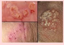 How much of a physical impact the virus has. Herbalist Sakura Health Centre Genital Herpes Is A Sexually Transmitted Disease Std Caused By A Herpes Simplex Virus Hsv It Can Cause Sores On Your Genital Or Rectal Area Buttocks And