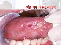 If you think chewing tobacco is a healthier alternative to smoking, think again. Oral Cancer Hindi Youtube
