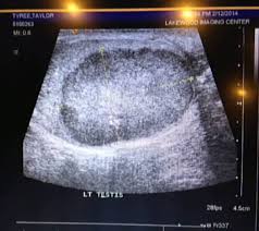 Testicular cancer is a disease that occurs when cancerous (malignant) cells develop in the tissues of a testicle. Reddit User Says Social Networking Site Helped Him Discover Testicular Cancer Gaming Entertainment Express Co Uk