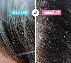 Image result for lice vs nits