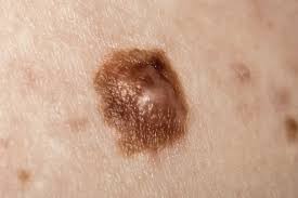 You can use these melanoma pictures as examples of melanoma pictures on arms to use as a reference. Melanoma Treatment Options At Each Stage