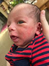 What is red circle rash with white spots?