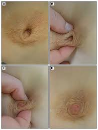 内衣下的秘密：这个乳头问题，不是无解的小烦恼－ 丁香园