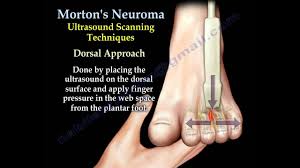 (like bone popping in and out) if i step on something hollow you ok, in feb i had lots of pain in my foot. Morton S Neuroma Everything You Need To Know Dr Nabil Ebraheim Youtube