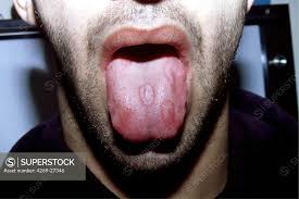 Image result for syphilis ulcer