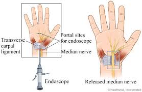 How long does it take for a broken wrist to stop hurting? After Carpal Tunnel Surgery Faq S Urban Hyve