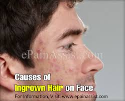 This clogging can force a hair to grow sideways (ouch), but. Causes Of Ingrown Hair On Face Tips To Deal With It